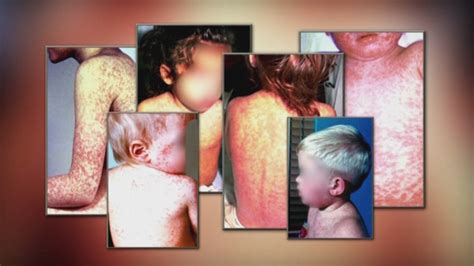 An Idaho man has measles. Health officials are trying to see if the disease has spread.